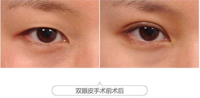 呼和浩特割双眼皮哪家医院好?