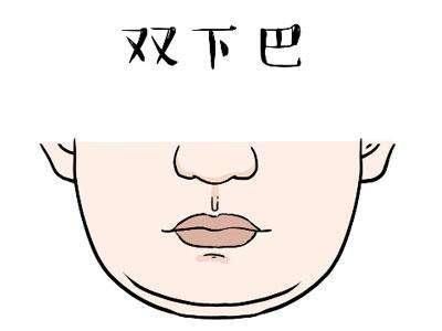 双下巴做吸脂的效果怎么样呢?