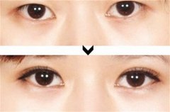 呼和浩特割双眼皮大概多少钱?