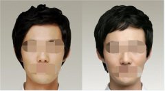 呼和浩特做自体软骨隆鼻大概多少钱?