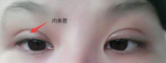 呼和浩特整形双眼皮术后为什么会出现腊肠眼？