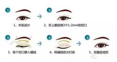 呼和浩特整形式三点双眼皮手术大概多少钱?