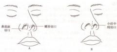 呼和浩特隆鼻手术会留疤痕吗?