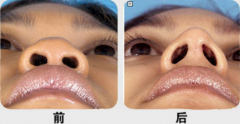 呼和浩特鼻尖整形大概多少钱?