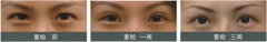 呼和浩特整形开眼角修复手术难吗?