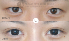 呼和浩特可以内外眼角都开吗?