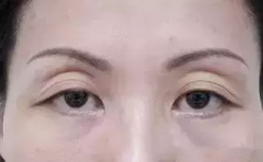 呼市整形眼窝凹陷该如何呢?