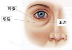 呼和浩特整形卧蚕与眼袋的区别?