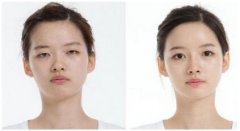 暑期整形提前预热 高考生加入整容大军