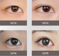 呼和浩特市韩式双眼皮 美丽眼睛从这开始