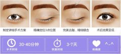 呼市割双眼皮哪里好?张高贵医疗美容韩式三点定位双眼皮