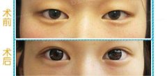 呼和浩特市眼部整形手术需要多少钱