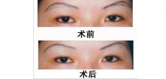 呼和浩特市哪家眼部整形医院好