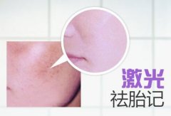呼和浩特市哪里有激光祛胎记的