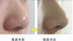 呼和浩特整形医院假体隆鼻多少钱呢?