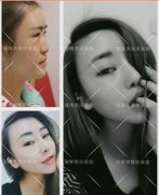 呼和浩特整形医院做鼻综合整形手术需要多少钱?
