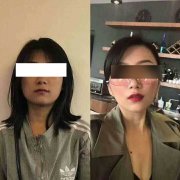 呼和浩特整形医院哪些人不适合打瘦脸针?