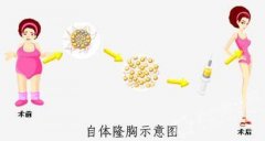 呼和浩特整形医院自体脂肪隆胸效果怎么样?