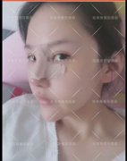 呼和浩特整形医院韩式隆鼻怎么样?