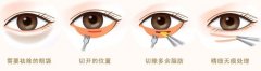 祛眼袋手术安全吗?