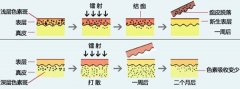 激光能不能去掉雀斑?