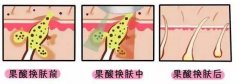 呼和浩特做完果酸换肤后需要注意些什么?