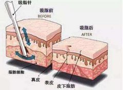 抽脂手术前需要注意什么?