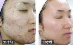 果酸换肤做一次多少钱?