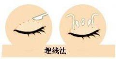 埋线双眼皮和全切双眼皮的区别有哪些?