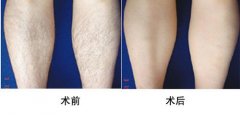 脱腿毛有什么有用的方法?