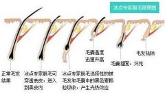 激光脱腋毛对身体排汗有害处吗?