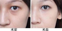 哪些方法可以去眼袋?