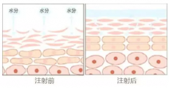 注射完水光针后的注意事项?