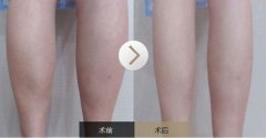 呼和浩特注射瘦腿针哪家医院效果好?