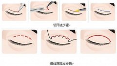 呼和浩特哪家做埋线双眼皮效果好?