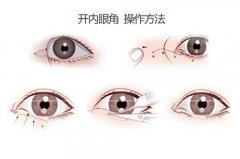 呼和浩特开外眼角手术效果怎么样?