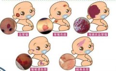 呼和浩特哪家医院祛胎记好?