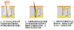 呼和浩特哪家医院激光脱毛好?
