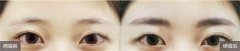 呼和浩特哪家医院纹眉好?