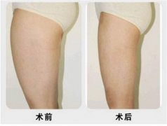 呼和浩特大腿抽脂得多少钱?