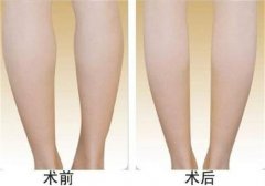 呼和浩特哪家医院做腿部吸脂效果好?