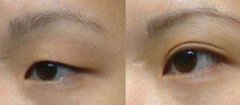 呼和浩特哪家医院做双眼皮整形效果好?
