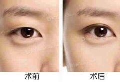 呼和浩特做全切双眼皮多少钱?