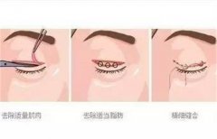 双眼皮修复手术多少钱?