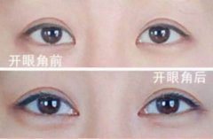 呼和浩特做开眼角手术多少钱?
