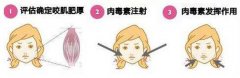 呼和浩特哪家医院瘦脸针效果好?