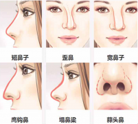 隆鼻术效果好不好?