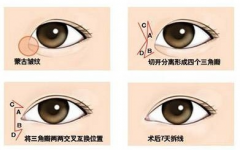 呼市开眼角手术会影响后遗症吗?