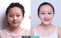 玻尿酸填充法令纹安全吗?