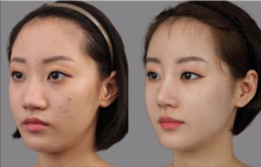 隆鼻后效果真实吗?